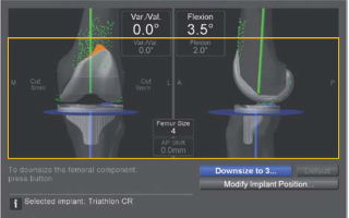 Видео презентация: эндопротезирование коленного сустава с использованием лазерной навигации