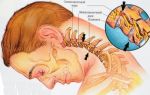 Головные боли при остеохондрозе шейного отдела: симптомы, лечение