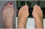 Артроз сустава большого пальца ноги: лечение