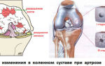 Лечение артроза коленного сустава народными средствами: рецепты