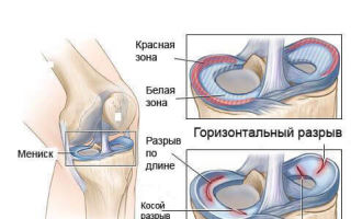 Разрыв заднего рога медиального мениска коленного сустава: лечение, симптомы, повреждение мениска