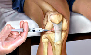 Блокада коленного сустава дипроспаном и другими медикаментами при артрозе