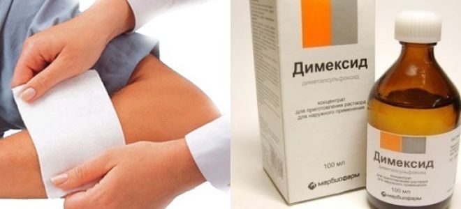 Остеопороз: симптомы и лечение, причины, что такое, как лечить