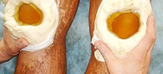 Реактивный артрит: симптомы и лечение, причины заболевания
