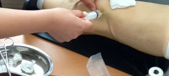 Пункция коленного сустава: как и зачем проводится