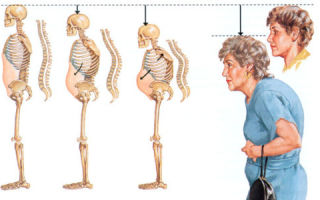 Гимнастика при остеопорозе: правила и рекомендации выполнения