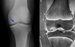 Болезнь кенига коленного сустава: лечение, причины, симптомы