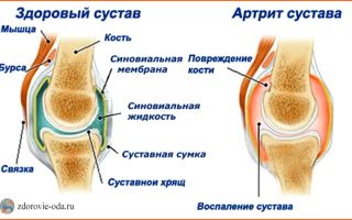 Артрит коленного сустава: симптомы и лечение, причины заболевания