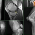 Тендинит коленного сустава — воспаление сухожилий: лечение колена