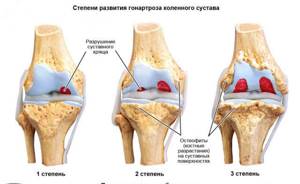 Гонартроз коленного сустава: что такое, лечение, симптомы, причины