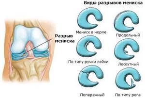 Разрыв мениска коленного сустава: симптомы, лечение без операции