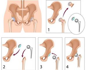 Операция по замене тазобедренного сустава: подробная инструкция