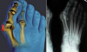 Остеоартроз стопы: симптомы и лечение мелких суставов