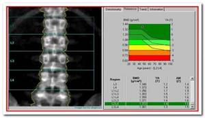 Диффузный остеопороз костей, поясничного отдела и позвоночника