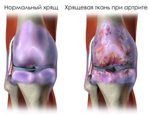 Артрит коленного сустава 1 и 2 степени: симптомы и лечение