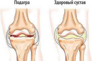 Жжение в коленном суставе: причины появления, методы лечения
