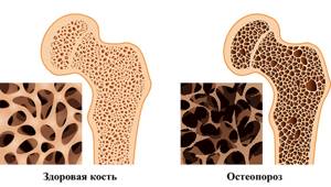 Остеопороз: какой врач лечит
