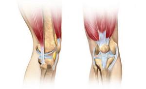 Лечение растяжения и разрыва связок коленного сустава в домашних условиях