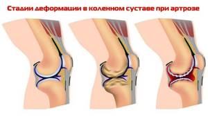 Как лечить артроз коленного сустава в домашних условиях: способы лечения