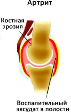 Болят суставы: лечение, причины появления боли в суставах