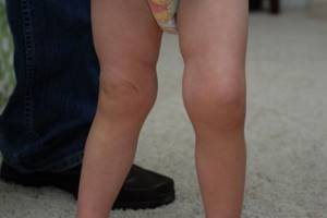 Ювенильный идиопатический артрит у детей: диагностика и лечение