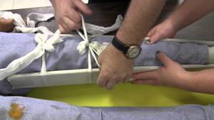 Видео: переломы проксимального отдела бедренной кости у пожилых