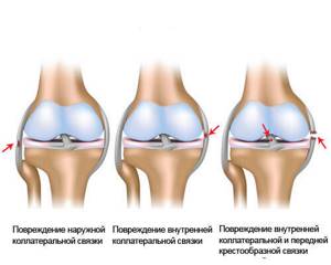 Видео: травмы коленного сустава и способы лечения