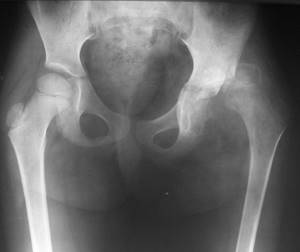 Остеохондрома бедренной кости: причины, симптомы и лечение