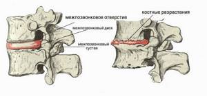 Можно ли умереть от остеохондроза шейного отдела: опасные признаки