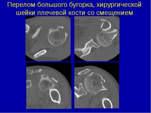 Видео презентация на тему переломов проксимального отдела большеберцовой кости. И.Г. Беленький (С-Петербург)
