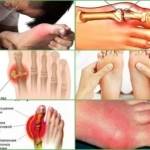 Симптомы и лечение инфекционного полиартрита суставов