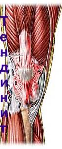Тендинит коленного сустава — воспаление сухожилий: лечение колена