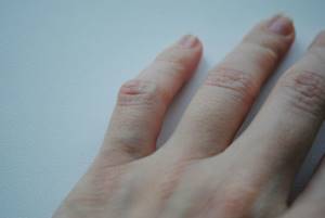 Шишки на пальцах рук: причины и лечение суставов кисти, фото