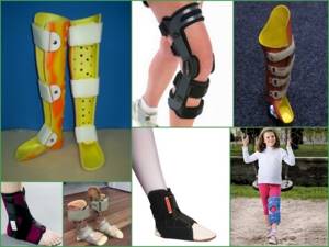 Ортопедические стельки при вальгусной деформации стопы у детей и взрослых: виды, принцип действия
