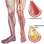 Гемартроз коленного сустава: лечение, симптомы, что это такое