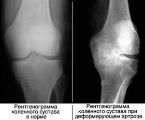 Лечение артроза коленного сустава 2 степени: симптомы, как лечить
