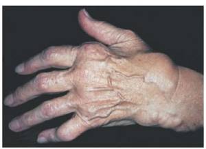 Ревматоидный артрит: симптомы, лечение, диагностика, что это такое, фото