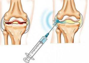 Уколы в коленный сустав при артрозе: препараты, инъекции в колено