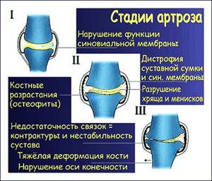 Остеоартроз коленного сустава 2 степени: лечение, причины, симптомы