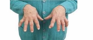 Чем лечить артрит кистей рук: способы, медикаменты и рецепты