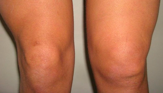 Как лечить бурсит коленного сустава в домашних условиях