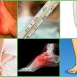 Артрит стопы: причины, симптомы и лечение, фото, диета
