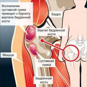 Воспаление тазобедренного сустава: симптомы и лечение