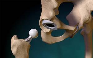 Асептический некроз головки тазобедренного сустава: лечение, последствия