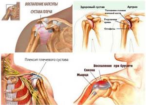 Хруст в плечевом суставе: при вращении, с болью и без. Причины и лечение