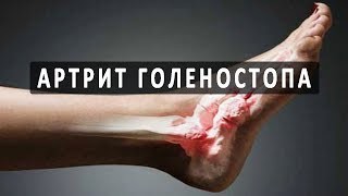 Видео презентация: боль в коленном суставе