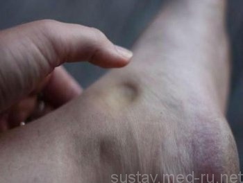 Боль и отек в голеностопном суставе: причины и лечение