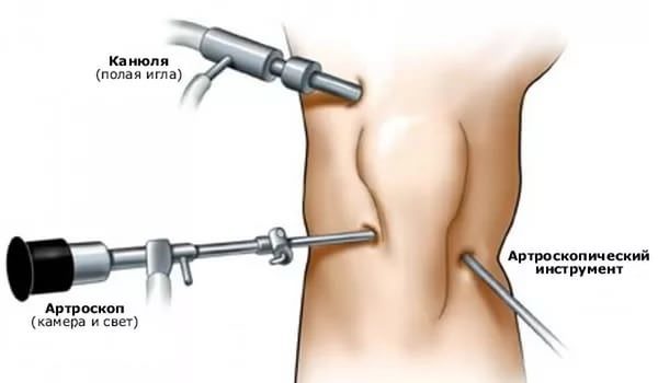 Артроскопия коленного сустава: что это такое, техника операции, отзывы