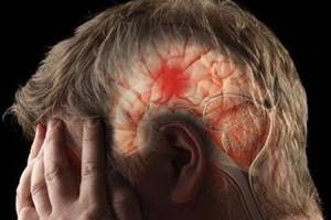 Нарушение мозгового кровообращения при шейном остеохондрозе: лечение