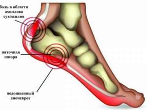 Тендинит ахиллова сухожилия: диагностика и лечения стопы